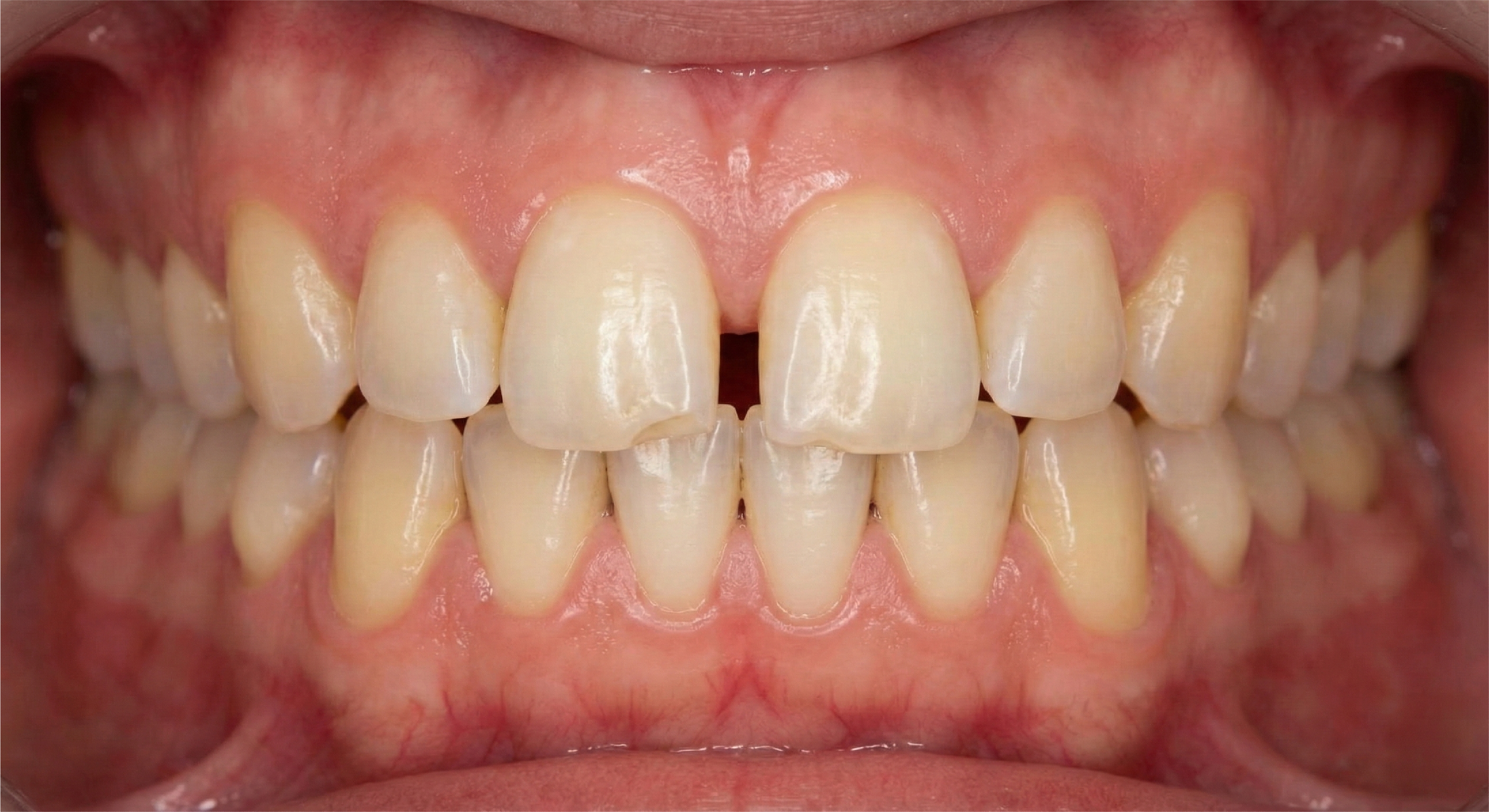 Before — Direct Composite Veneers